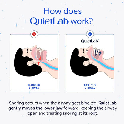 QuietLab Pro® Anti-Snoring Mouthpiece